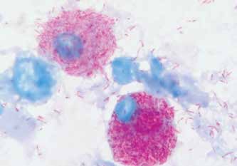 Окраска по Цилю-Нильсену: четыре макрофага, два из которых содержат значительное количество положительно окрашенных палочковидных бактерий (микобактерий), которые также видны на фоне препарата