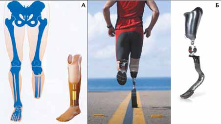 А – Принцип использования протеза с культеприемной гильзой; Б – спортивный вариант протеза