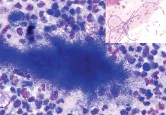 Нейтрофильное воспаление с нитевидными бактериями: значительное количество дегенеративных нейтрофилов, единичные макрофаги и плотная крупная группа (мат) тонких нитевидных бактерий. В правом верхнем углу – фрагмент клетки плоского эпителия с наложением ни