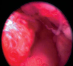 Рис. 9. Вентрикулоскопия 4-го желудочка. Новообра- зование головного мозга у стафордширского буль- терьера