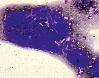 Метастаз рака железистого строения (рак желудка), асцитическая жидкость, азур-эозин, ×200