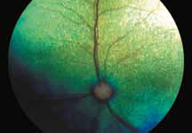 Цветное фото глазного дна (левый глаз – классическая вариация нормы; правый глаз – «тигроидное» глазное дно)