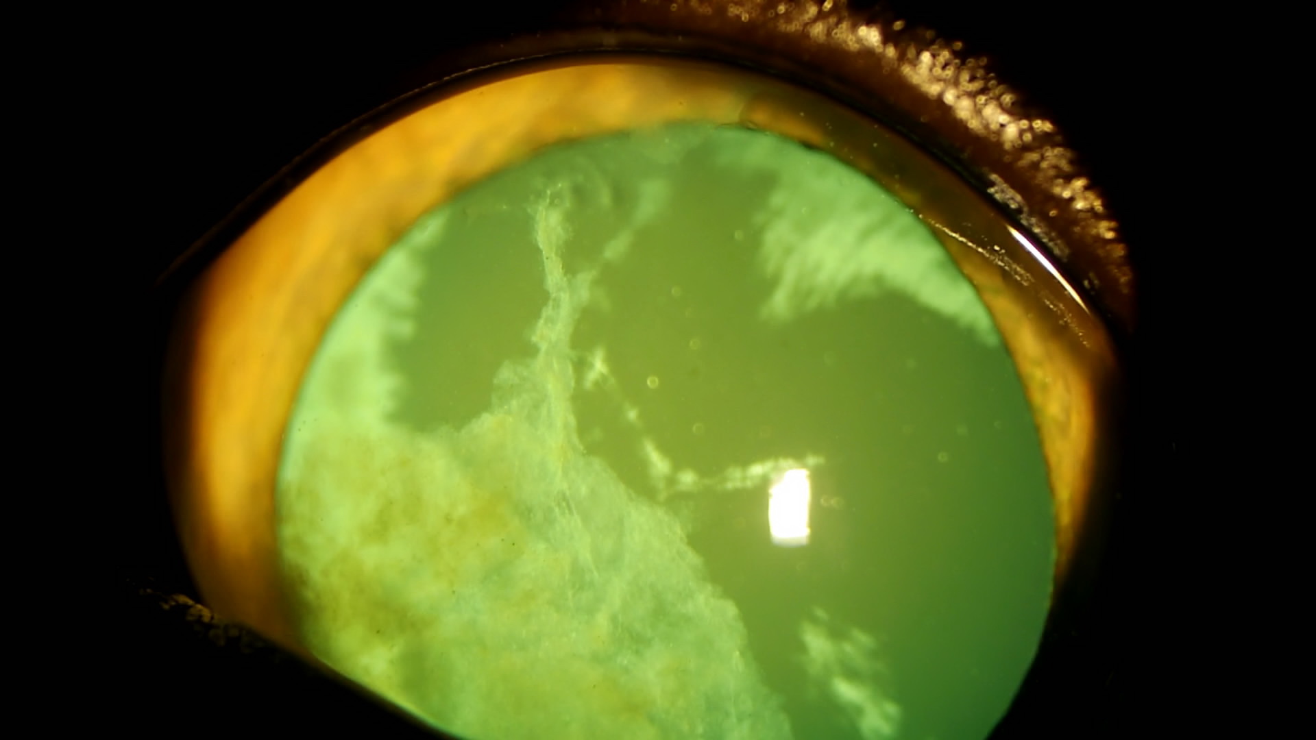 Рис 11 Биомикроскопия переднего отрезка левого глаза у кошки с FeLV с Рис.1 и правого глаза с Рис.3