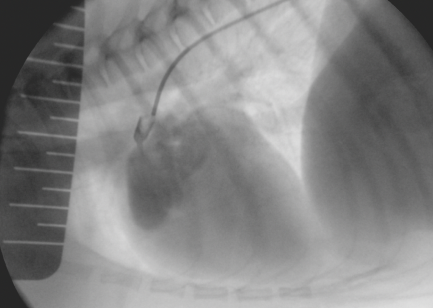 Рентгеноскопический снимок. Катетер в ОАП. Визуализация ампулы и остриума отличная
