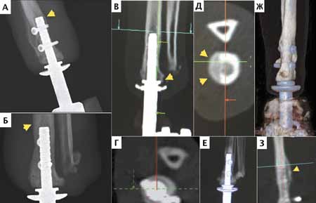 А, Б – рентгенограммы после ЧОП предплечья через 13 месяцев. Желтыми стрелками отмечается гипертрофия костной ткани в проксимальной области эндопротеза (зона 1, 14 по Gruen). Рентгенологических признаков нестабильности (зон остеолизиса) не выявлено; В-З –