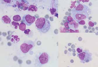 Выпот в грудную полость, окраска по Романовскому: макрофаги, нейтрофилы, малые лимфоциты; в некоторых макрофагах визуализируются палочковидные неокрашенные структуры
