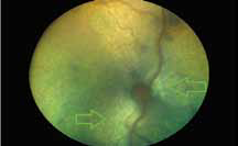 Мультифокальные изменения на сетчатке правого глаза в виде складок у кота с вирусной лейкемией, коронавирусной инфекцией и панлейкопенией с признаками двустороннего переднего увеита и хориоретинита, гипервискозного синдрома