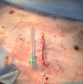 Вид операционной раны после наложения интрадермального шва