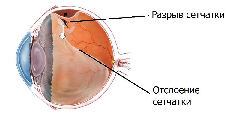 Рисунок 1. Схематический вид глазного яблока в разрезе при отслоении и разрыве сетчатки.
