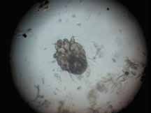Чесоточный клещ Sarcoptes sc. при микроскопии соскоба