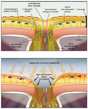 Рисунок 5. Схематическое изображение воздействия повышенного ВГД на сетчатку и зрительный нерв