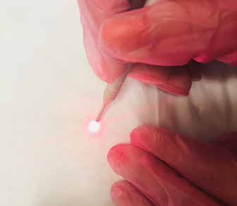 Зонд диодного лазера для транссклерального лечения глаукомы