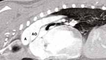 КТ-ангиография. Изображение получено на 16-срезовом томографе. По центру рисунка представлена дуга аорты (А) и ампула открытого артериального протока (АО )