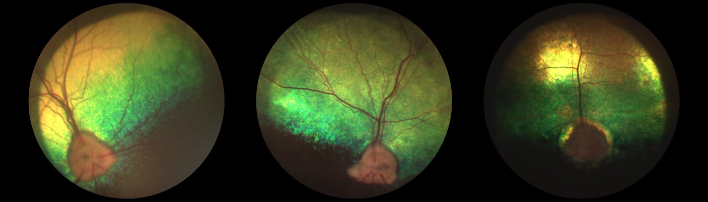 Рисунок 9. Офтальмоскопическая картина сетчатки и ДЗН при различных стадиях глаукоматозного процесса. Начальная стадия (слева), развитая стадия (в центре), терминальная стадия (справа)