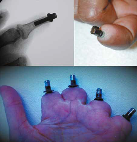 Внутрикостные ITap-протезы, разработанные для людей, перенесших ампутацию пальцевых фаланг (Примечание: ITap-протезы (англ. Intraosseous Transcutaneous Amputation Prosthesis) «внутрикостный чрескожный ампутационный протез»)