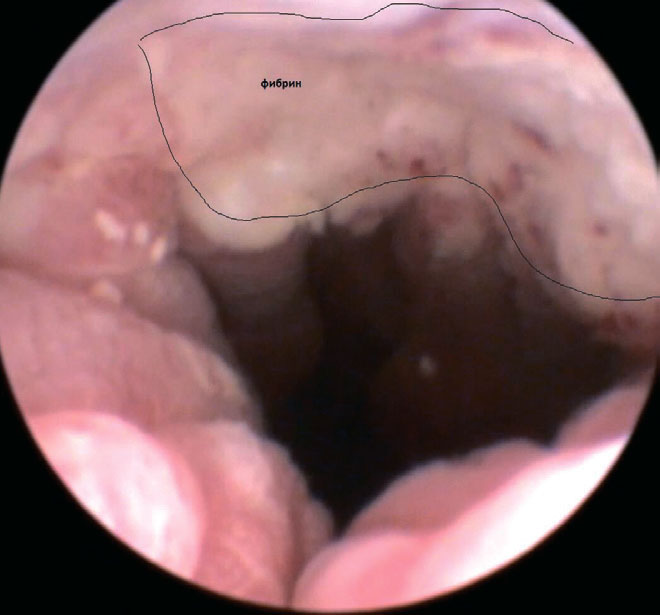 Уретроскопия. Неопластическая ткань на дорсальной поверхности уретры