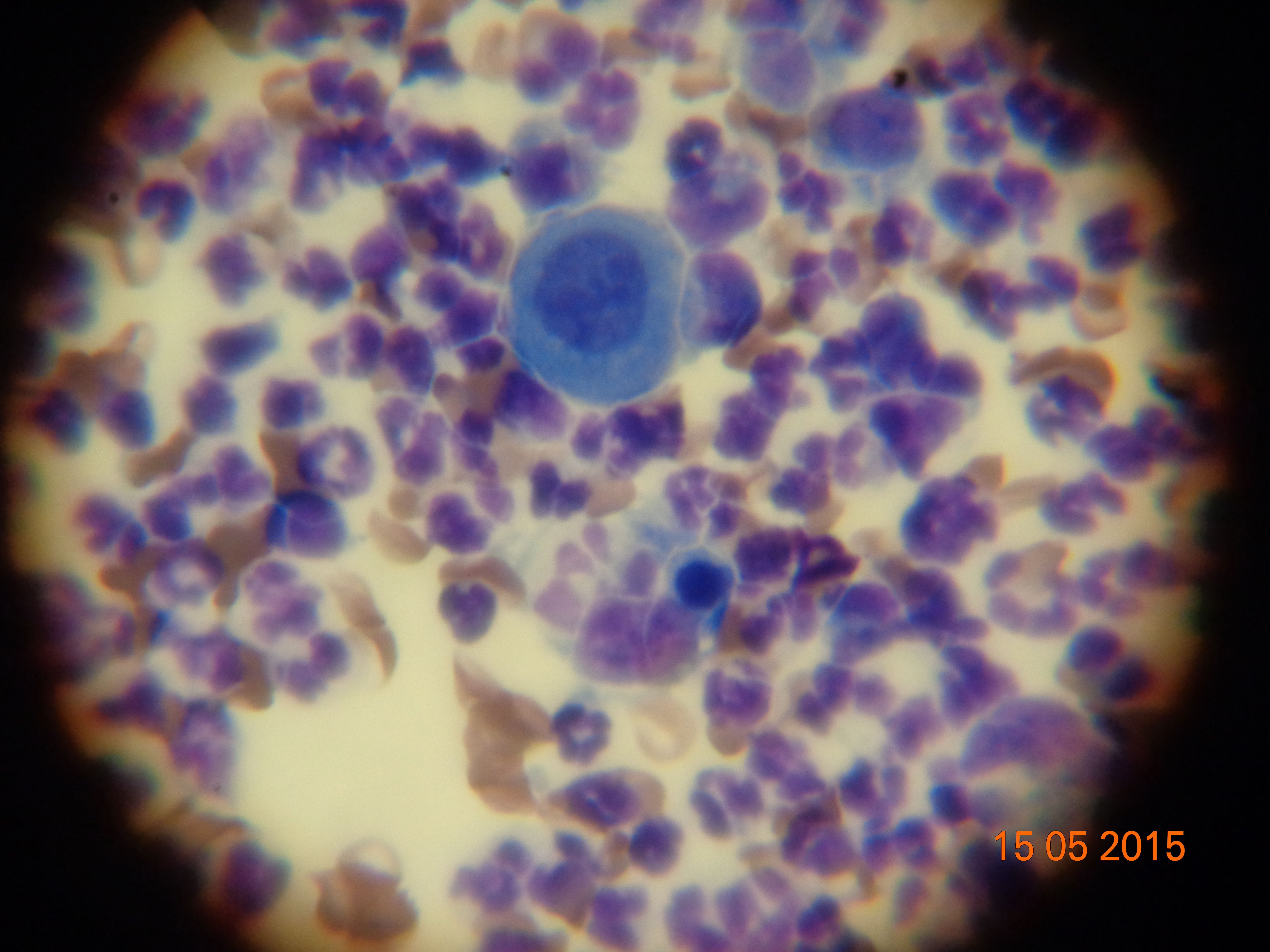 Фото 1. Цитология из пустулы при листовидной пузырчатке: недегенерированные нейтрофилы и акантолитический кератиноцит (крупная округлая клетка с центрально расположенным ядром и базофильной цитополазмой, более интенсивно окрашенной по периферии клетки)