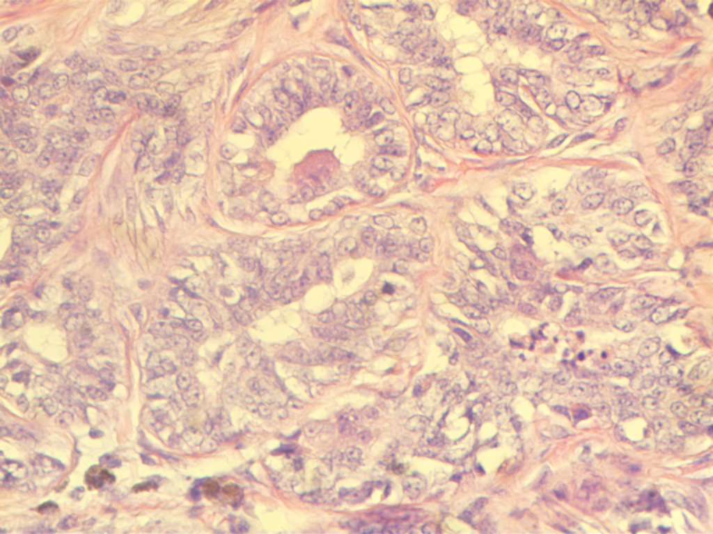 Рис. 6. Тубулярный рак молочной железы. Опухолевые клетки формируют тубулярные структуры, выявляются множественные фигуры митоза. Окраска гематоксилином и эозином. Увеличение: окуляр х10, объектив х40.