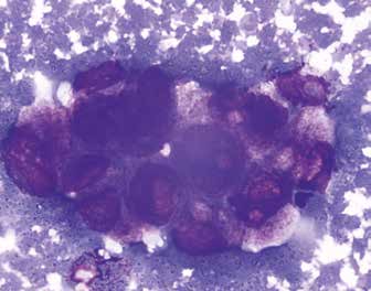 Метастаз рака железистого строения (рак легкого), плевральная жидкость, азур-эозин, ×1000