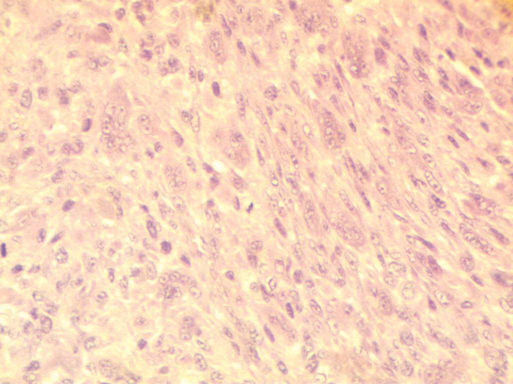 Рис. 2. Злокачественная фиброзная гистиоцитома. Ткань с признаками смешанного генеза, сформирована атипичными фибробластоподобными клетками и гигантскими многоядерными клетками. Окраска гематоксилином и эозином. Увеличение: окуляр х10, объектив х40.