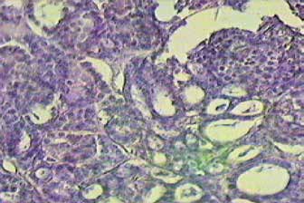 Гистологическая картина умереренно-дифференцированного рака молочной железы комплексного типа. Увеличение *4, *10, *40,*100. Окраска гемотоксилин-эозин
