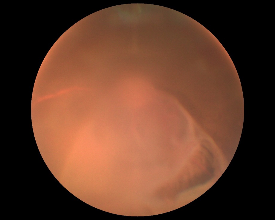 Рисунок 5. Офтальмоскопическая картина глазного дна при тотальной ОС у собаки с участками разрыва.