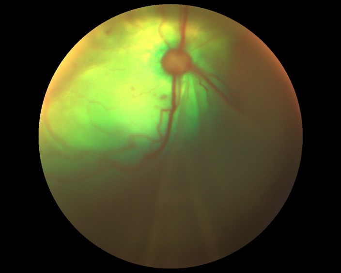 Рисунок 12. Офтальмоскопическая картина глазного дна кошки с артериальной гипертензией и ОС.