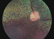 Самоед с первичной закрытоугольной терминальной глаукомой правого глаза. Признаки застоя ДЗН, перипапиллярная отслойка сетчатки с кровоизлияниями и патологические изменения по ФАГ . Левый глаз на момент осмотра стабилен