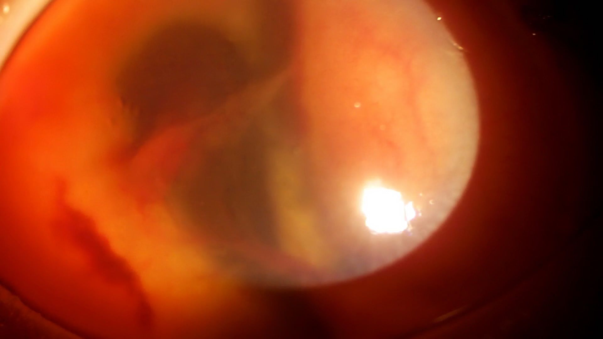 Биомикроскопия переднего отрезка левого глаза