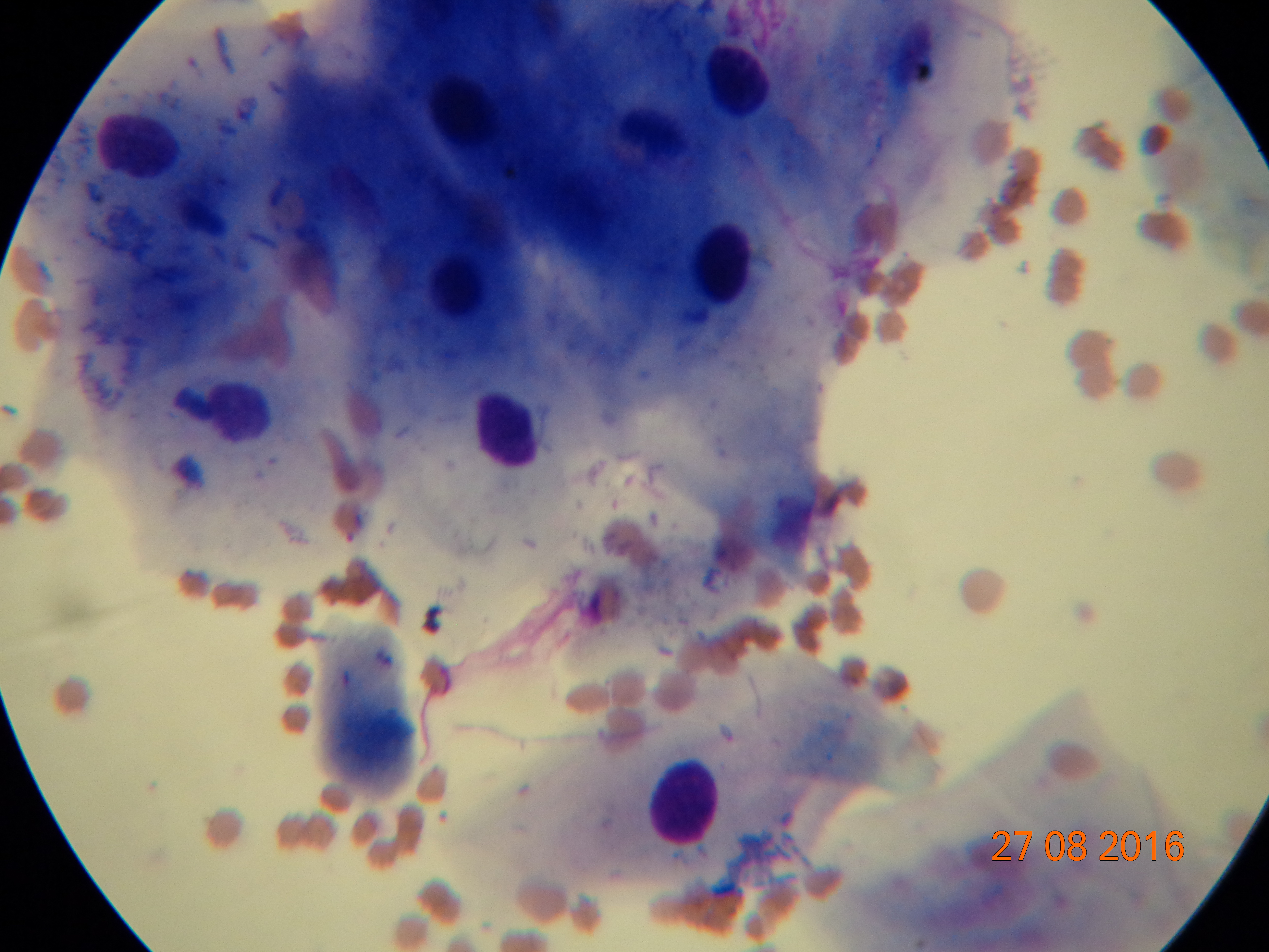 Паракератозные кератиноциты в соскобе, окрашенном по Паппенгейму. Большое количество бактерий связано с вторичной инфекцией