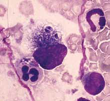 Тахизоиты Toxoplasma gondii при бронхи- альном лаваже у кошки. Несколько тахизо- итов находятся внутри макрофага (Гимза, × 1250) [17]