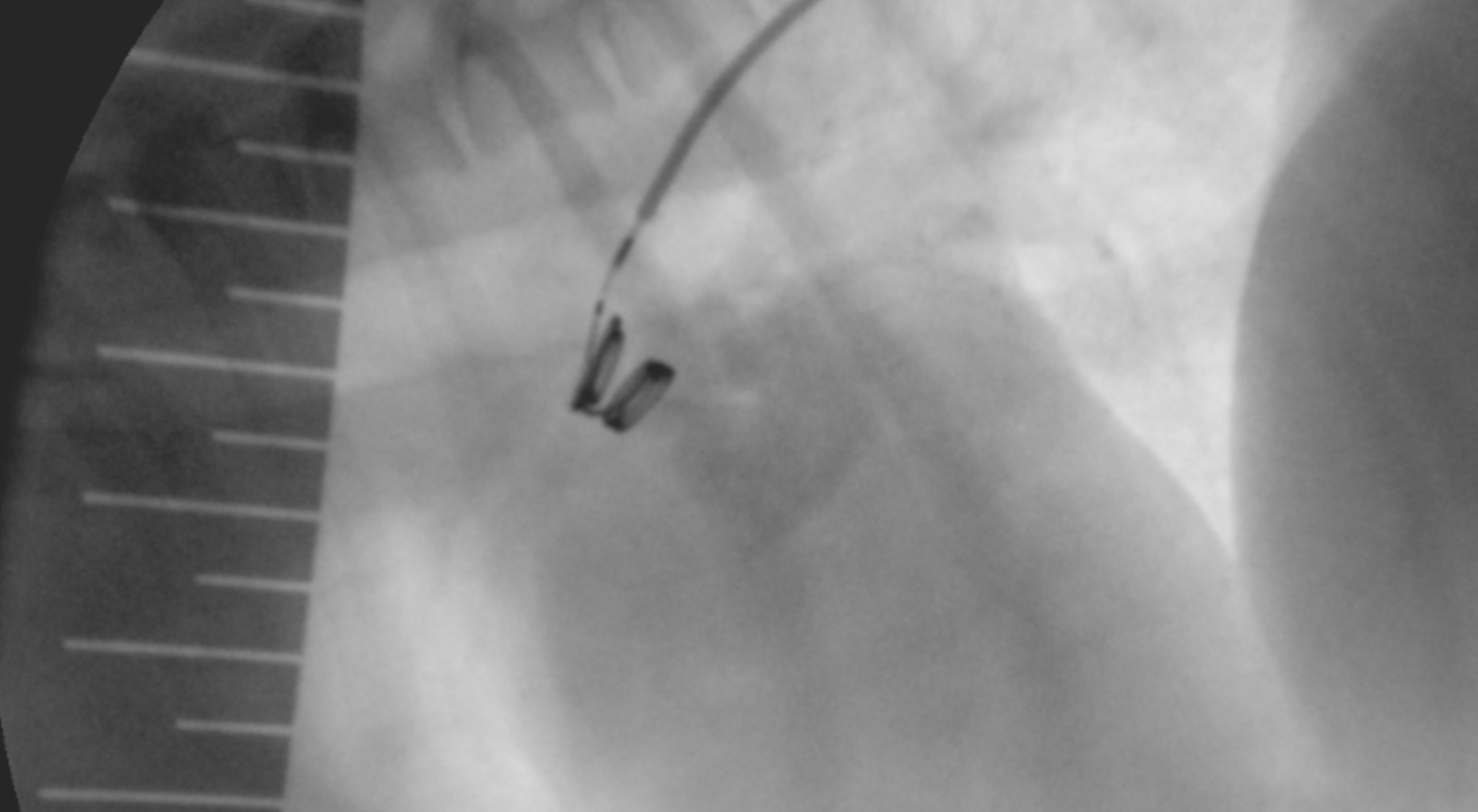 Рентгеноскопический снимок. Витки спирали раскрыты в стволе легочной артерии