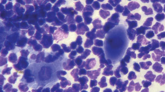 Акантолитические клетки и недегенеративные нейтрофилы из асептической пустулы при листовидной пузырчатке (окуляр 10, объектив 100)