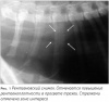        .     / Clinical case of malignant tracheal obstruction in older cat. Short-term outcome of palliative therapy